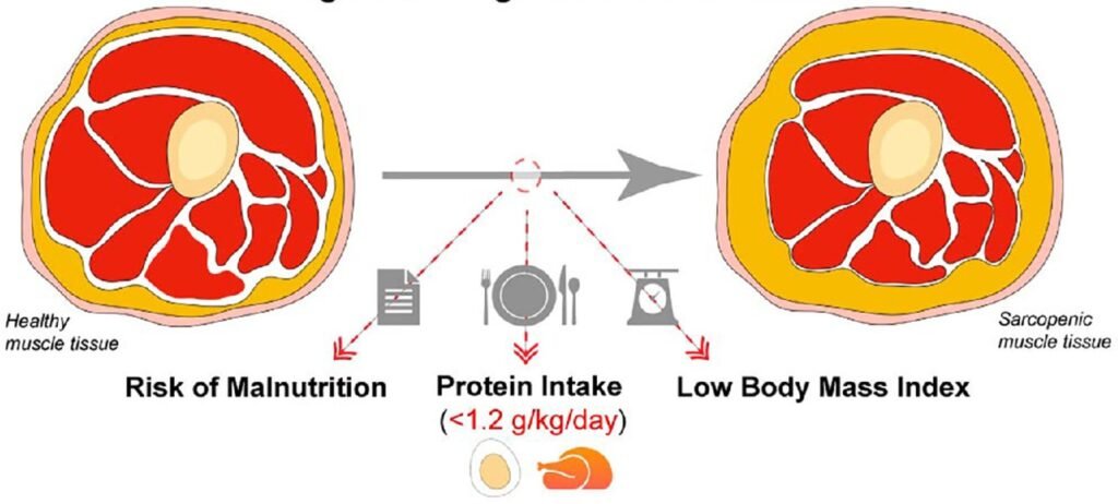 YOUR QUICK GUIDE ON SARCOPENIA: THE 'SILENT ROBBER' OF MUSCLE 3 Modifiable risk factors of sarcopenia in nursing home residents: addressing elderly-specific concerns